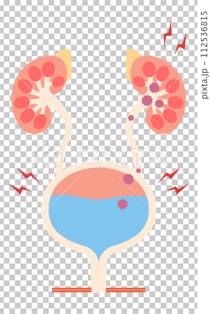 腎盂腎炎の医療イラスト、細菌が膀胱から腎臓に逆流する流れ 腎盂腎炎の医療イラスト、細菌が膀胱から腎臓に逆流する流れ 112536815