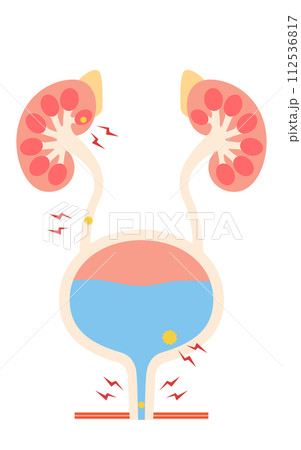 尿路結石の医療イラスト、腎結石・尿管結石・膀胱結石・尿道結石 尿路結石の医療イラスト、腎結石・尿管結石・膀胱結石・尿道結石 112536817