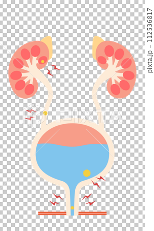 尿路結石の医療イラスト、腎結石・尿管結石・膀胱結石・尿道結石 尿路結石の医療イラスト、腎結石・尿管結石・膀胱結石・尿道結石 112536817