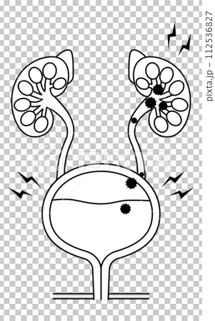 腎盂腎炎の医療イラスト、細菌が膀胱から腎臓に逆流する流れ 112536827