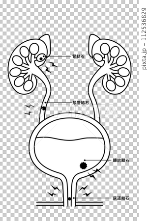 尿路結石、腎結石、輸尿管結石、膀胱結石、尿道結石的醫學插圖 112536829