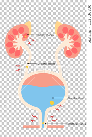 Medical illustration of urinary tract stones, kidney stones, ureteral stones, bladder stones, urethral stones Medical illustration of urinary tract stones, kidney stones, ureteral stones, bladder stones, urethral stones 112536830
