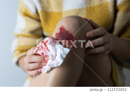 出血した膝の手当てをする女性(顔なし) 出血した膝の手当てをする女性(顔なし) 112572852