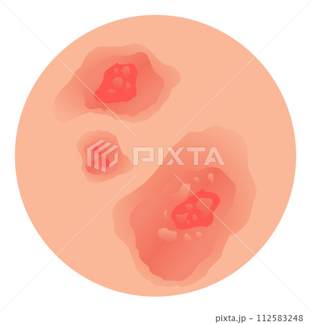 Type of psoriasis vector. Part of patients skin with dermatitis, inflammation, red rash and other skin problems. Cartoon illustration for disease concept 112583248