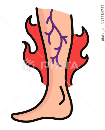 Varicose treatment icon. Violation of circulatory system. Vascular disease diagnostic. Venous insufficiency medical disease. Vector illustration Varicose treatment icon. Violation of circulatory system. Vascular disease diagnostic. Venous insufficiency medical disease. Vector illustration 112584785
