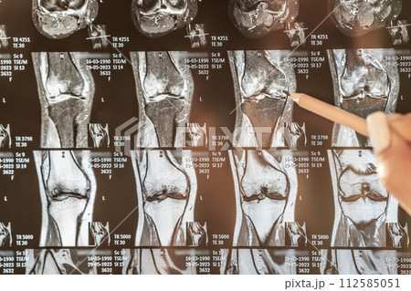 Knee joint x-ray or MRI. Doctor pointed on area of knee joint, where pathology or problem is detected, such fracture, destruction of joint, osteoarthritis, magnetic resonance enterography. 112585051