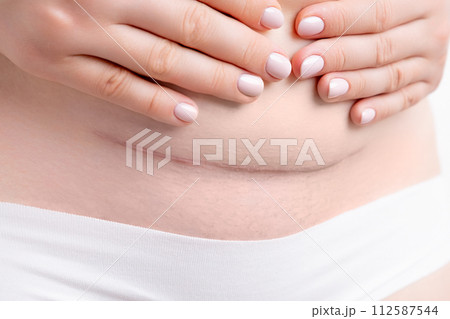 Woman belly with a big scar from a cesarean section. Woman belly with a big scar from a cesarean section. 112587544