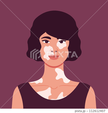 Beautiful young woman with vitiligo depigmentation. Rare appearance. Portrait or an avatar. Vector illustration Beautiful young woman with vitiligo depigmentation. Rare appearance. Portrait or an avatar. Vector illustration 112612407