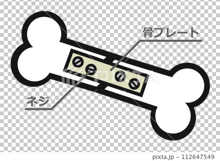 事故でホネが折れて骨折した治療イラスト 112647549