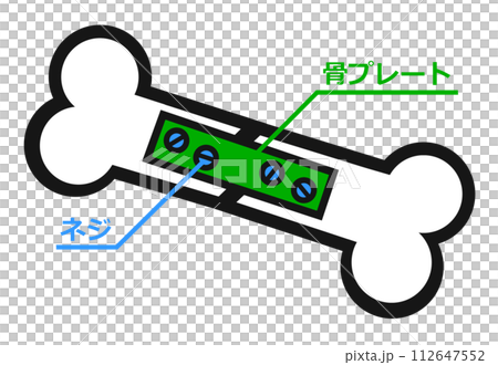 Illustration of treatment for broken bone due to accident Illustration of treatment for broken bone due to accident 112647552