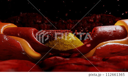 blood stream and cholesterol plaque, thrombus. health harm concept. Inside human body. blood stream and cholesterol plaque, thrombus. health harm concept. Inside human body. 112661365