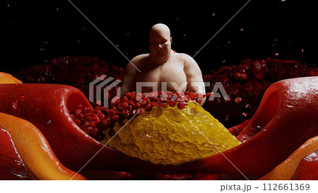 Fat man, blood stream and cholesterol plaque, thrombus. health harm concept. Inside human body. 3d rendering 112661369