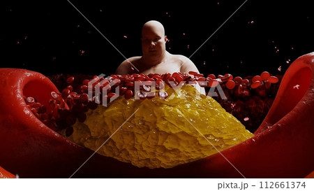 Fat man, blood stream and cholesterol plaque, thrombus. health harm concept. Inside human body. 3d rendering 112661374