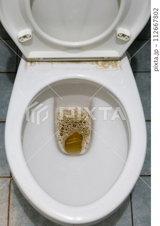 Yellowish urine with bubble in toilet bowl 112667802