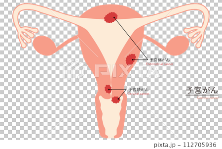 子宮癌圖解、子宮和卵巢解剖圖 子宮癌圖解、子宮和卵巢解剖圖 112705936