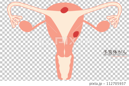Illustrated illustration of uterine cancer, anatomical diagram of the uterus and ovaries 112705937
