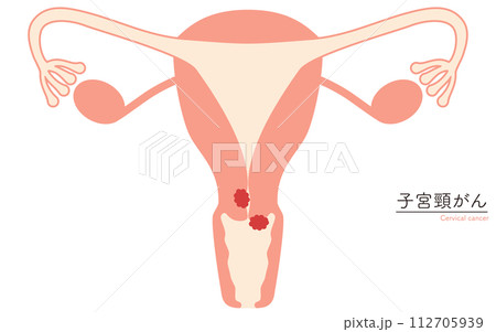 子宮頸がんの図解イラスト、子宮・卵巣の解剖図 112705939