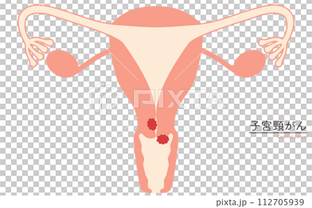 子宮頸がんの図解イラスト、子宮・卵巣の解剖図 112705939