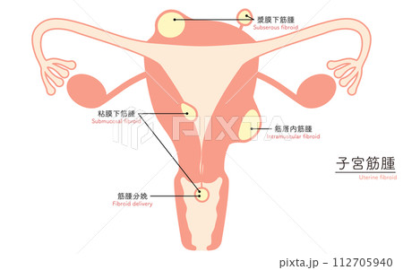 子宮筋腫の図解イラスト、子宮・卵巣の解剖図 112705940