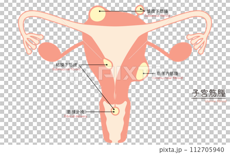 子宮筋腫の図解イラスト、子宮・卵巣の解剖図 112705940