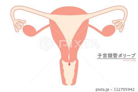 子宮頚管ポリープの図解イラスト、子宮・卵巣の解剖図 112705942