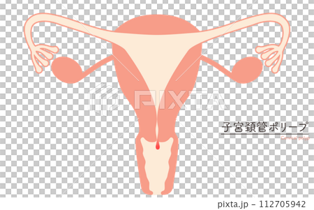 子宮頚管ポリープの図解イラスト、子宮・卵巣の解剖図 112705942