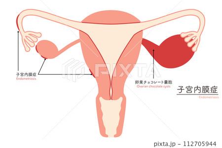 子宮内膜症の図解イラスト、子宮・卵巣の解剖図 112705944