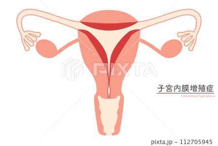子宮内膜増殖症の図解イラスト、子宮・卵巣の解剖図 112705945