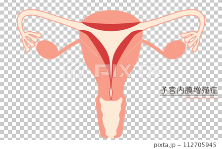 子宮内膜増殖症の図解イラスト、子宮・卵巣の解剖図 112705945