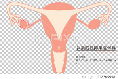 多囊性卵巢症候群（成熟障礙）插圖、子宮和卵巢解剖圖 112705948