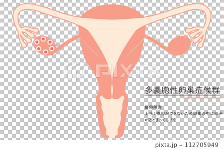 多囊性卵巢症候群(排卵障礙)插圖、子宮和卵巢解剖圖 多囊性卵巢症候群(排卵障礙)插圖、子宮和卵巢解剖圖 112705949