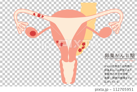 卵巢癌 II 期插圖，子宮和卵巢的解剖圖 112705951