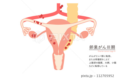 卵巣がんIII期の図解イラスト、子宮・卵巣の解剖図 112705952