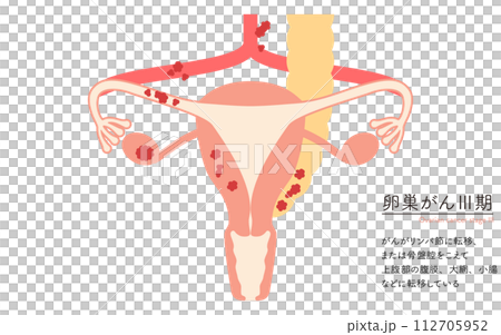 Illustrated illustration of ovarian cancer stage III, anatomical diagram of the uterus and ovaries 112705952