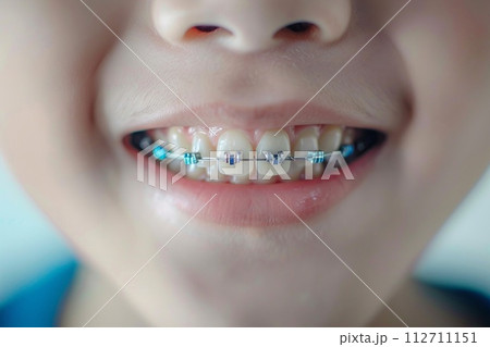 AI-generated content. A detailed close-up of a child's smile showing modern orthodontic braces with colorful bands on healthy teeth. 112711151