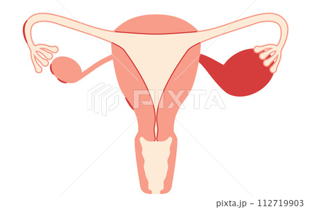 子宮内膜症の図解イラスト、子宮・卵巣の解剖図 112719903