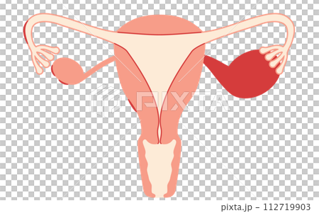 子宮内膜症の図解イラスト、子宮・卵巣の解剖図 112719903
