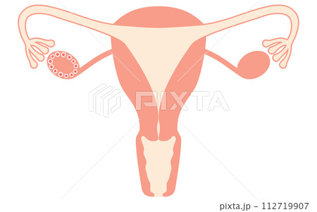 多嚢胞性卵巣症候群（成熟障害）の図解イラスト、子宮・卵巣の解剖図 112719907