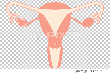多嚢胞性卵巣症候群（成熟障害）の図解イラスト、子宮・卵巣の解剖図 112719907