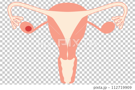 Illustrated illustration of ovarian cancer stage I, anatomical diagram of the uterus and ovaries 112719909
