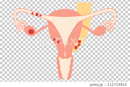 Illustrated illustration of ovarian cancer stage II, anatomical diagram of the uterus and ovaries Illustrated illustration of ovarian cancer stage II, anatomical diagram of the uterus and ovaries 112719910