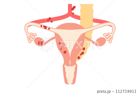 卵巣がんIII期の図解イラスト、子宮・卵巣の解剖図 卵巣がんIII期の図解イラスト、子宮・卵巣の解剖図 112719911
