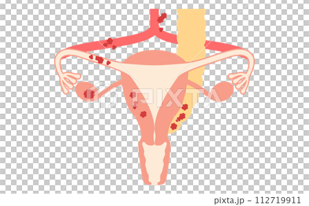 卵巣がんIII期の図解イラスト、子宮・卵巣の解剖図 卵巣がんIII期の図解イラスト、子宮・卵巣の解剖図 112719911