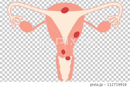 Illustrated illustration of uterine cancer, anatomical diagram of the uterus and ovaries Illustrated illustration of uterine cancer, anatomical diagram of the uterus and ovaries 112719916
