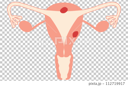 子宮癌圖解、子宮和卵巢解剖圖 112719917