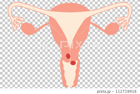 Illustrated illustration of cervical cancer, anatomical diagram of the uterus and ovaries Illustrated illustration of cervical cancer, anatomical diagram of the uterus and ovaries 112719918