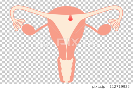 Illustrated illustration of endometrial polyps, anatomical diagram of the uterus and ovaries Illustrated illustration of endometrial polyps, anatomical diagram of the uterus and ovaries 112719923