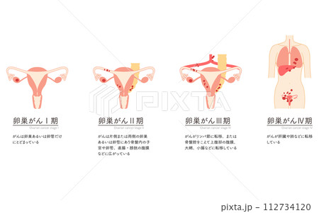 卵巣がんI期の図解イラスト、子宮・卵巣の解剖図 112734120