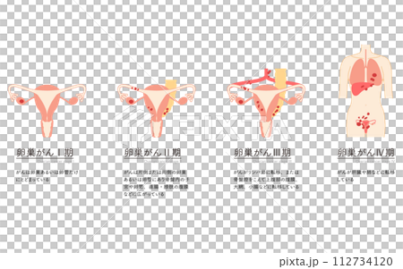 卵巣がんI期の図解イラスト、子宮・卵巣の解剖図 112734120