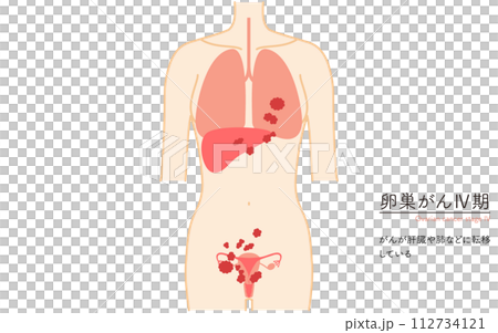 卵巢癌 IV 期圖解,子宮和卵巢的解剖圖 卵巢癌 IV 期圖解,子宮和卵巢的解剖圖 112734121